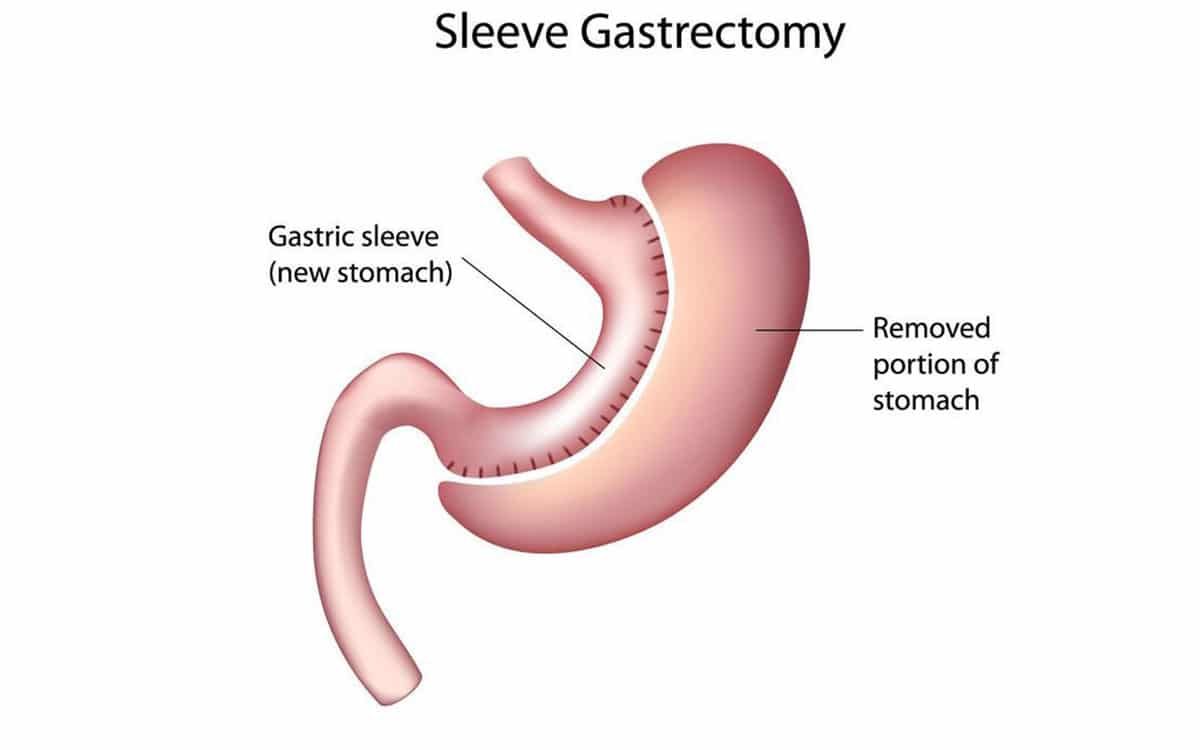 weight loss surgery