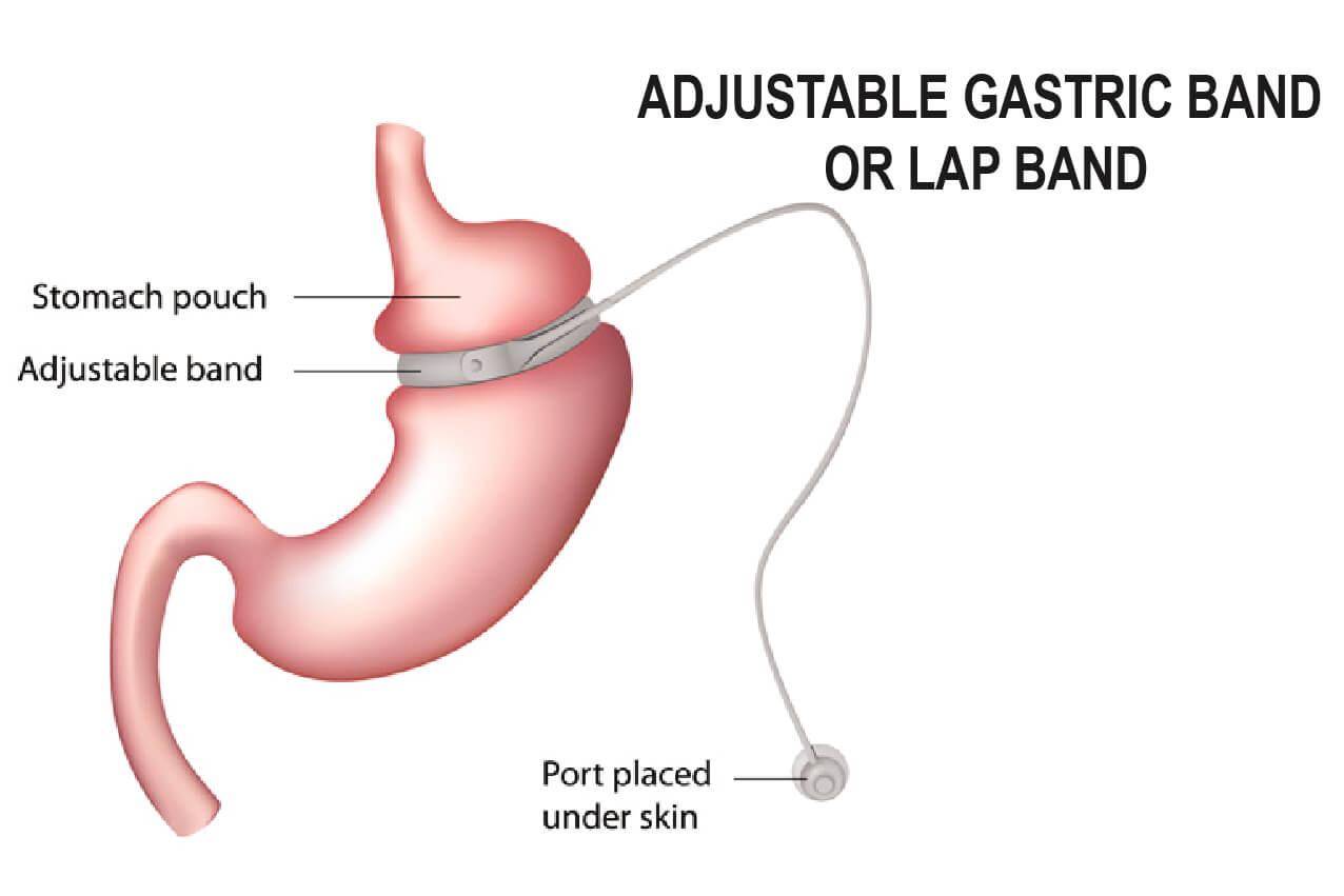 weight loss surgery