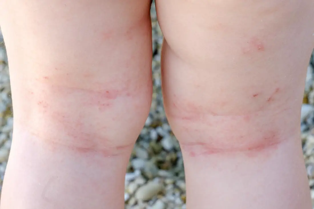 blotchy skin on legs
