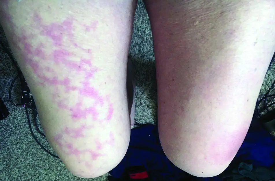 blotchy skin on legs