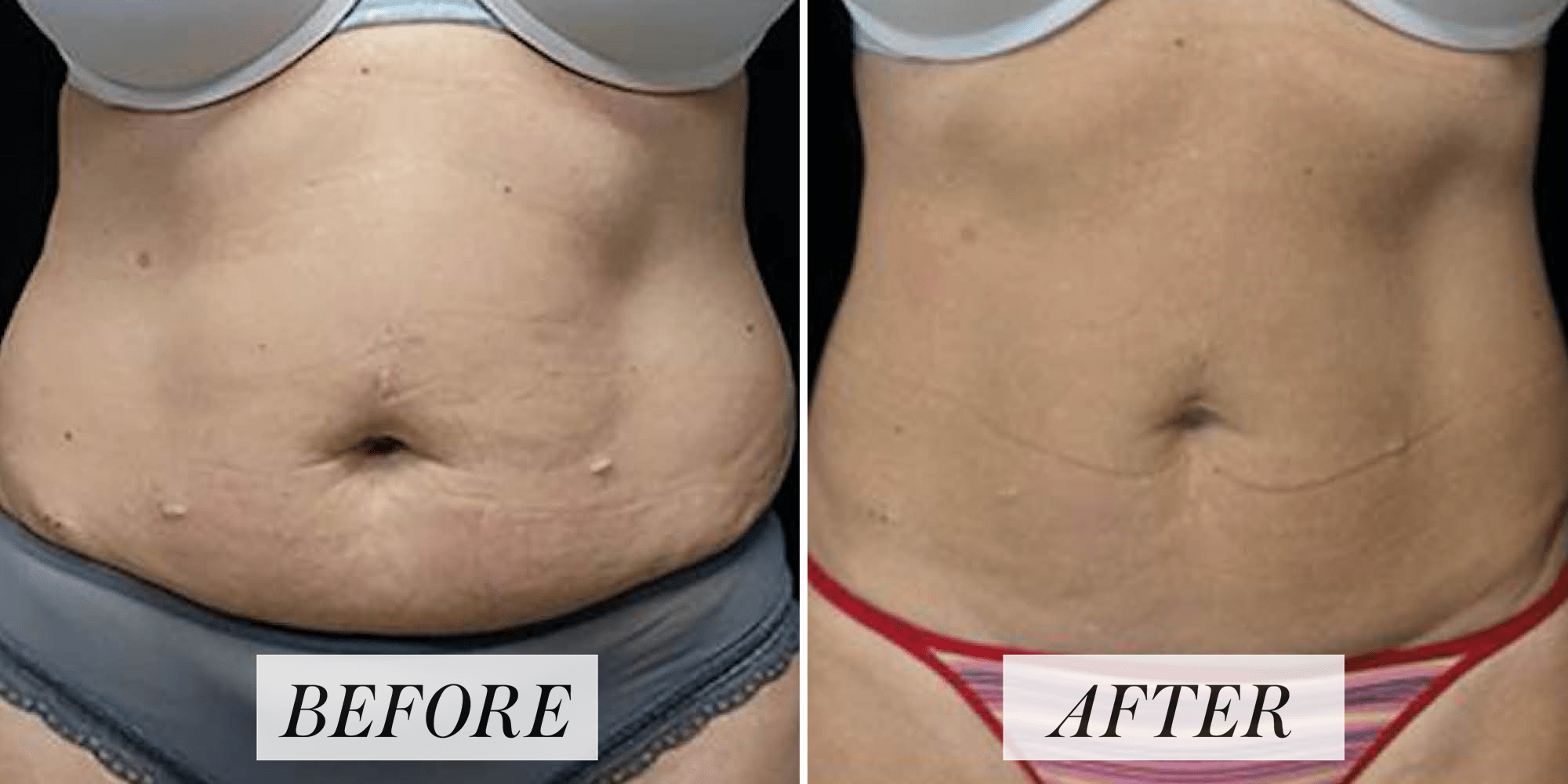 How to tighten loose belly skin