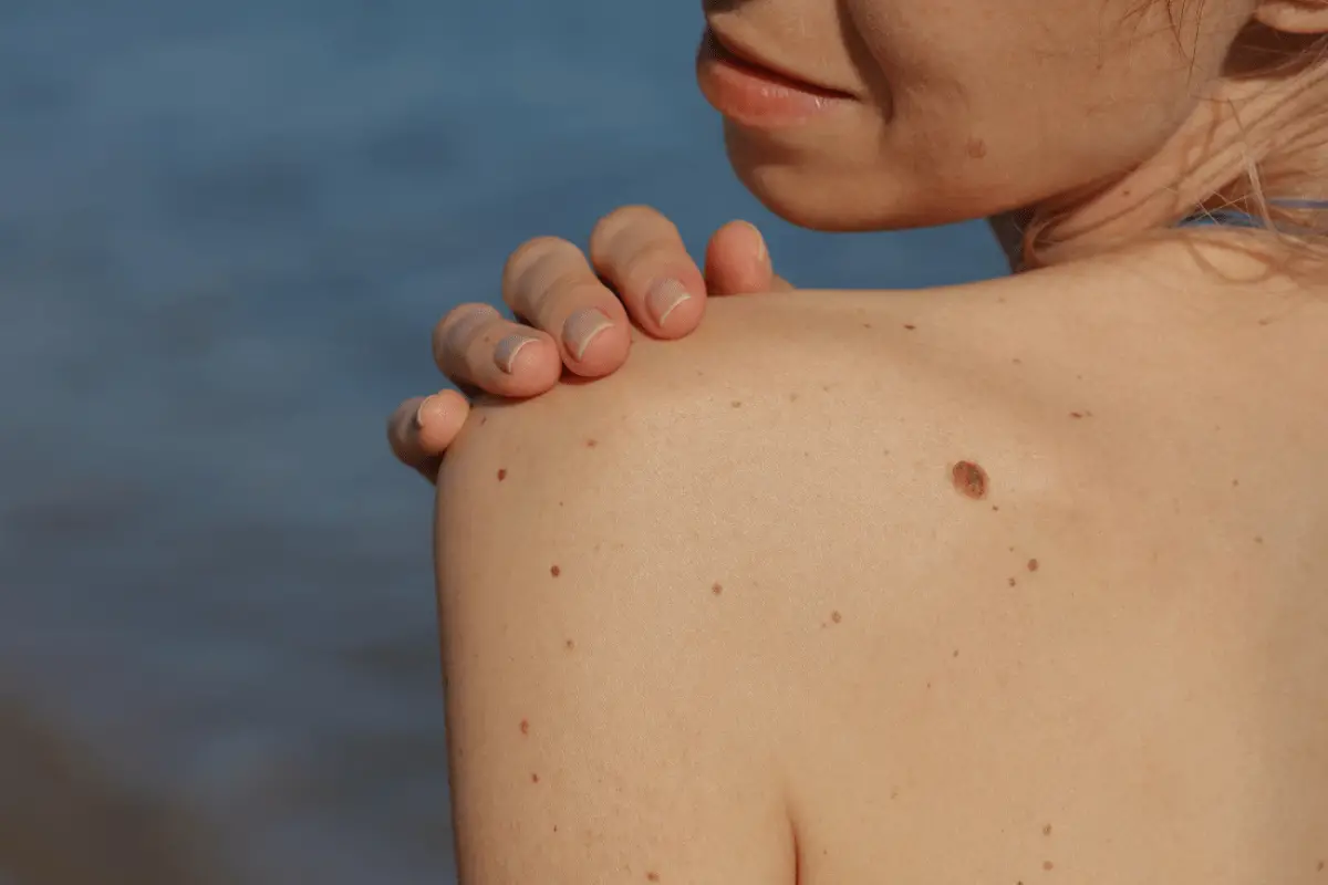 How To Remove Skin Tags- 3 Amazing Ways