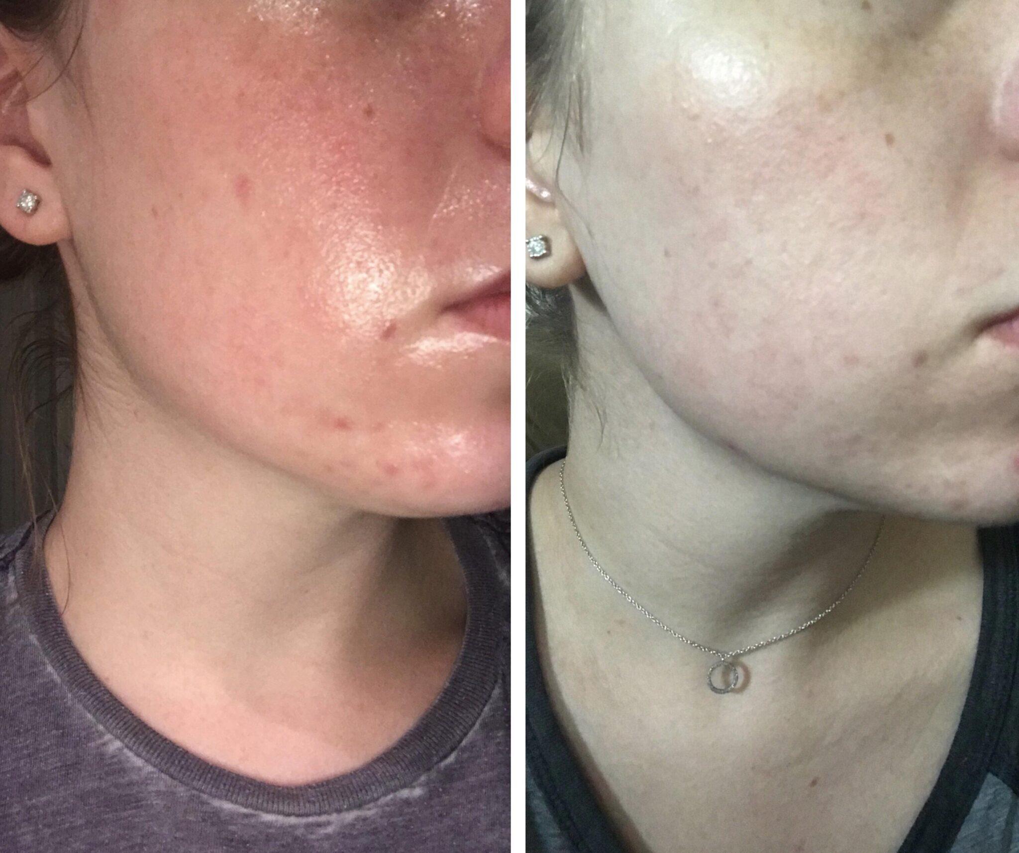 B&A] One month since adding Vitamin C and hyaluronic acid : SkincareAddiction