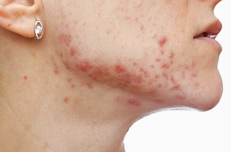 fungal acne treatment