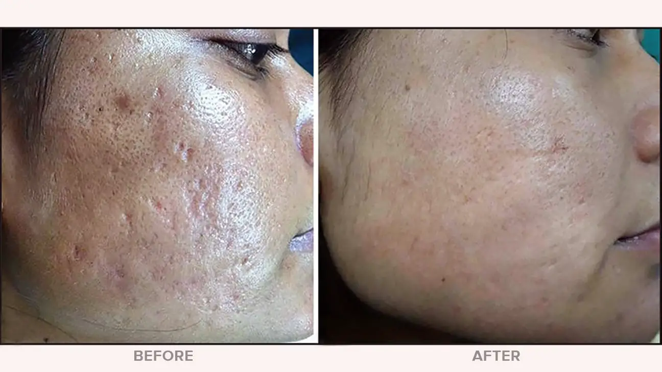 micro-needling before and after