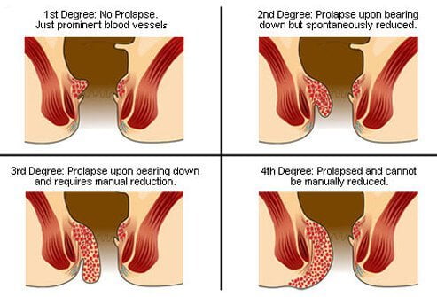 How Long Do Hemorrhoids Last