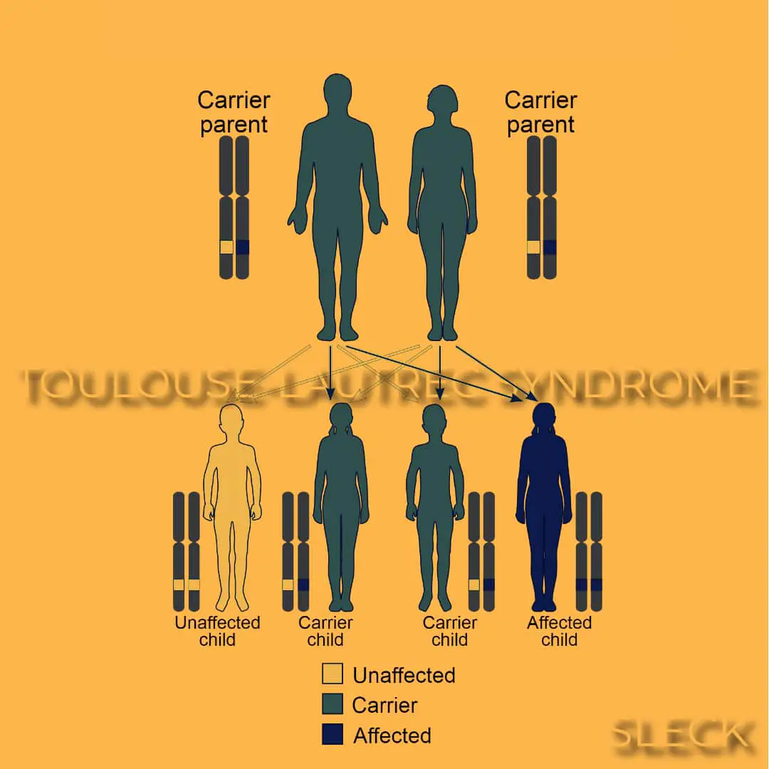 What is The Toulouse-Lautrec Syndrome? Know more about Pycnodysostosis