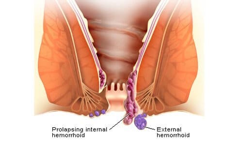 how long do hemorrhoids last