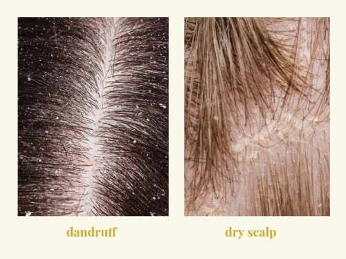 dandruff vs dry scalp