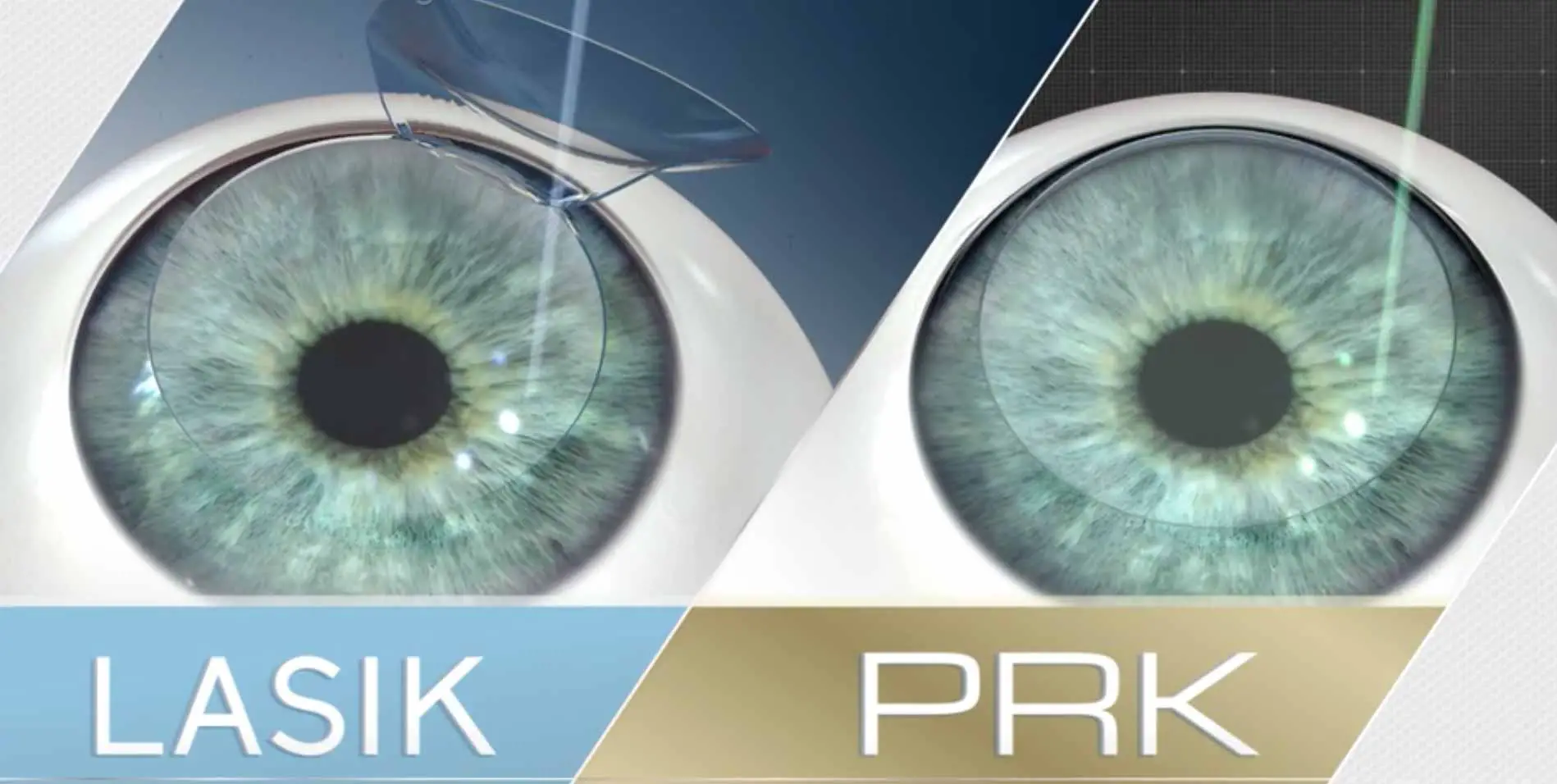prk-vs-lasik