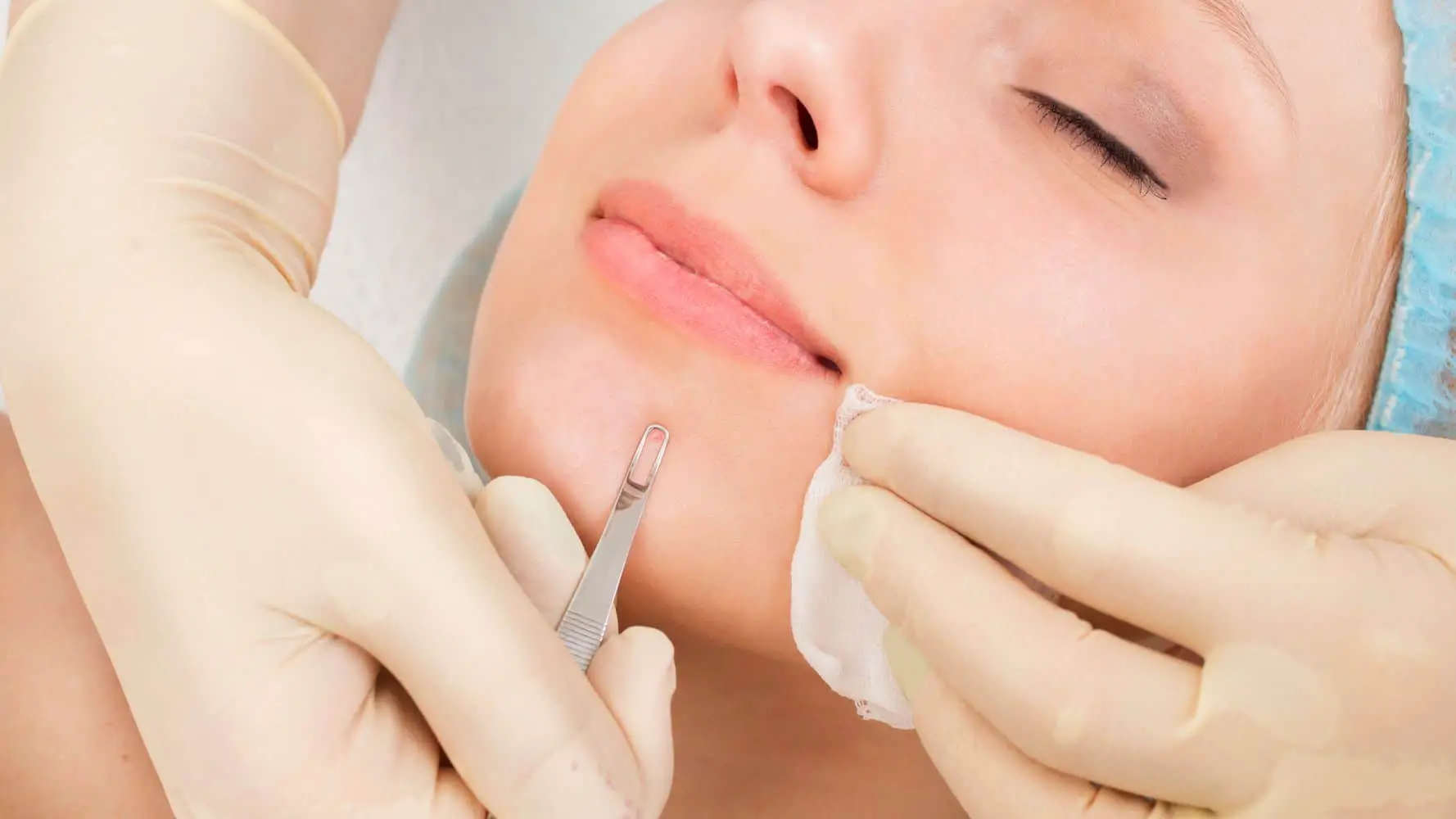 Blackhead Removal Tool and Its Benefits