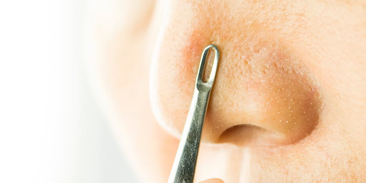 blackhead removal tool