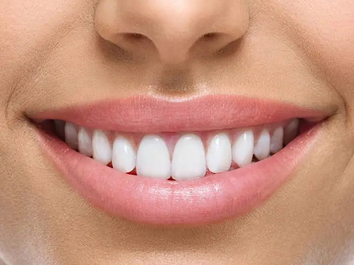 How much do veneers cost