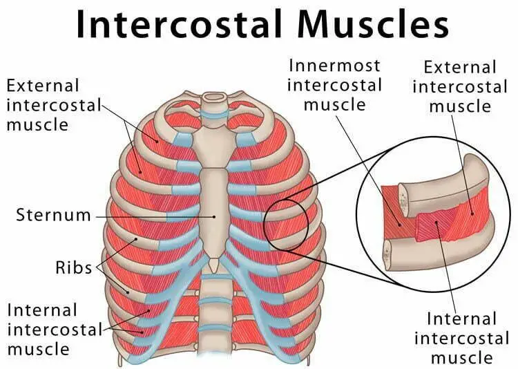 intercostal muscle strain