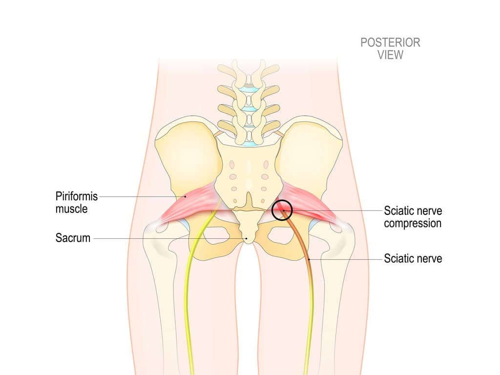 pinched nerve in the hip