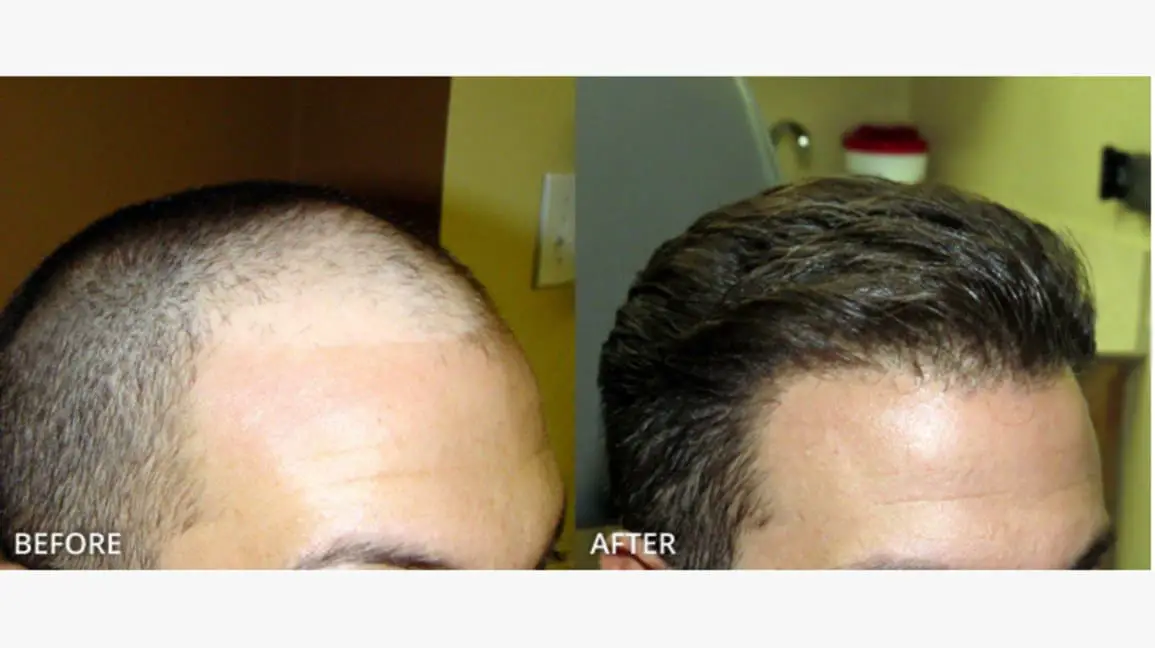 fue hair transplant