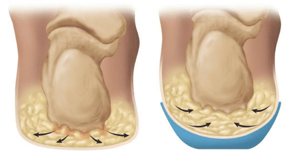 heel pad syndrome