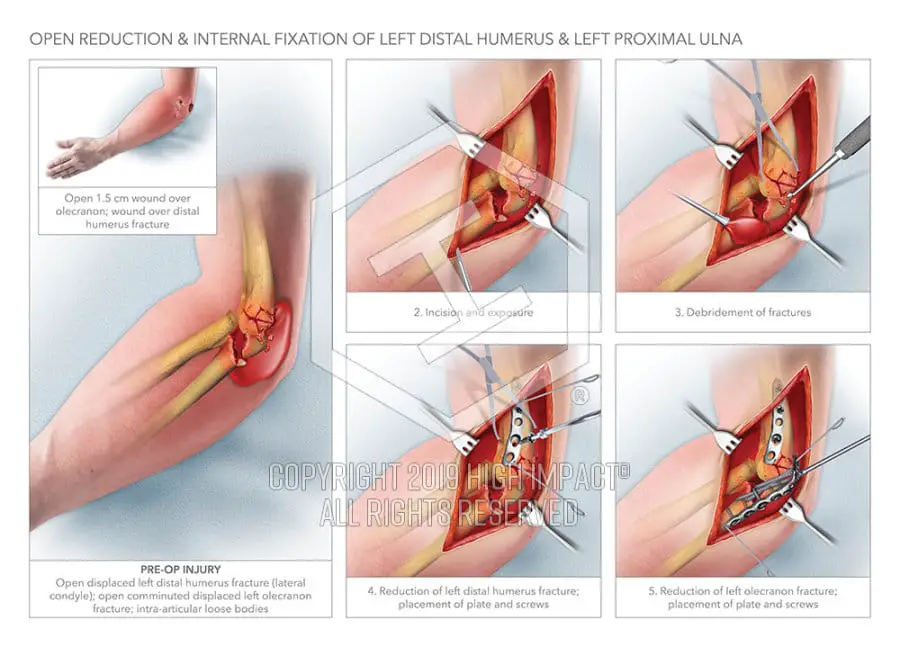 open reduction internal fixation