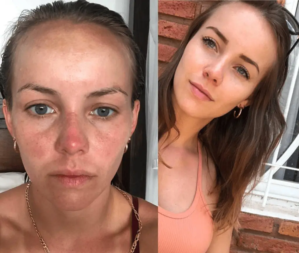 tretinoin before and after