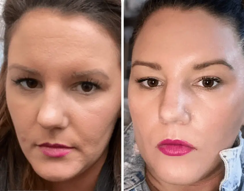 tretinoin before and after