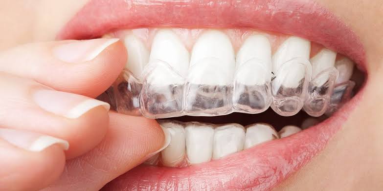 How much does Invisalign Cost? – 5 Amazing Ways to Reduce the Cost