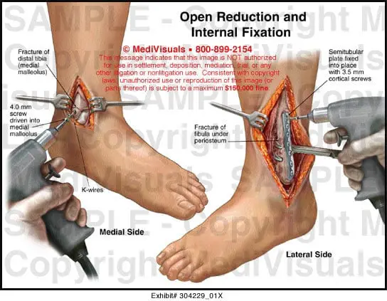 Open reduction internal fixation