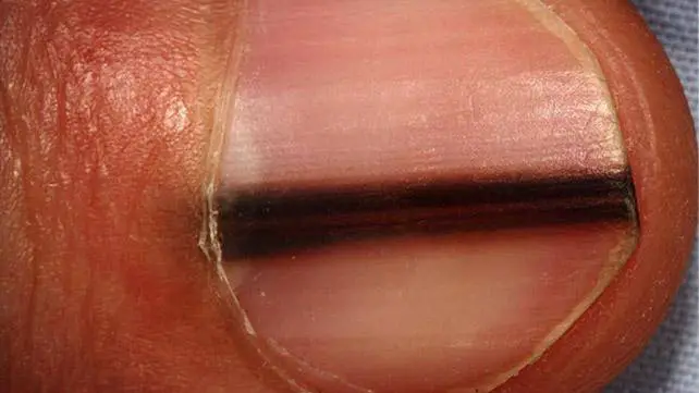 black line on nail
