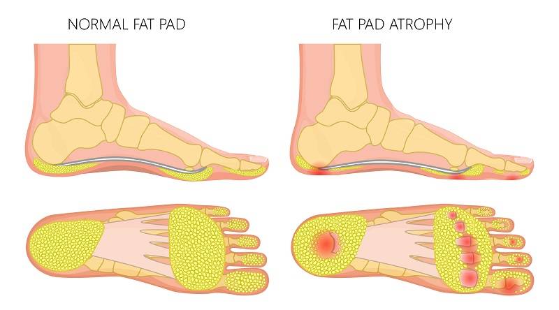 heel pad syndrome