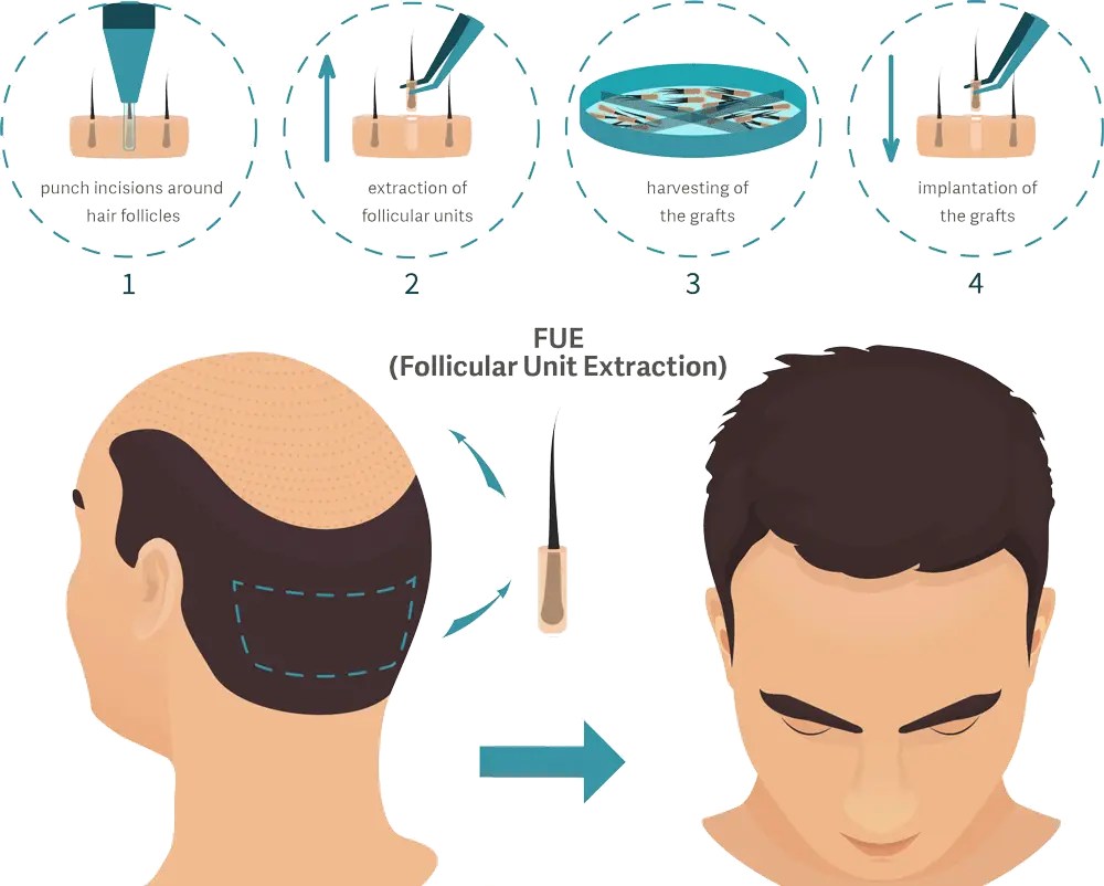 fue hair transplant