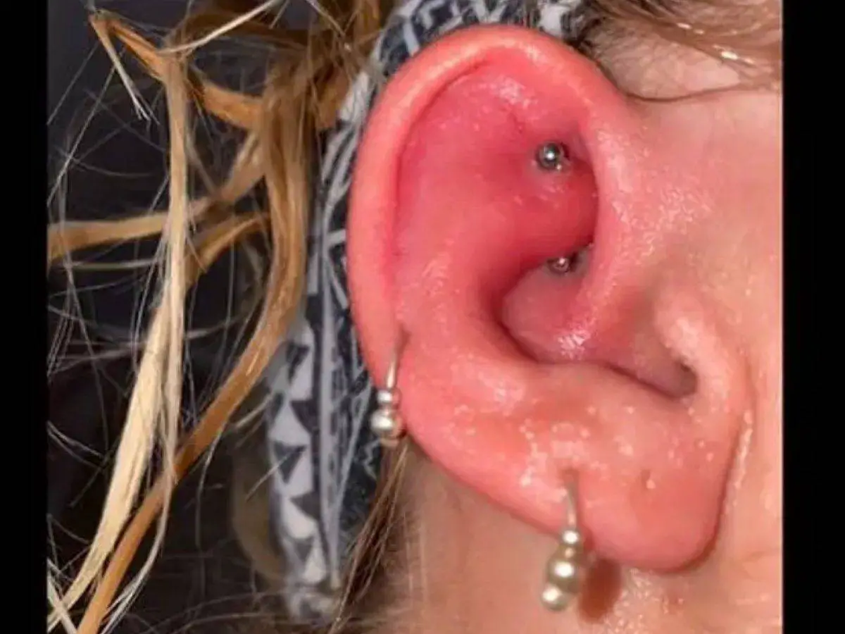infected ear piercing