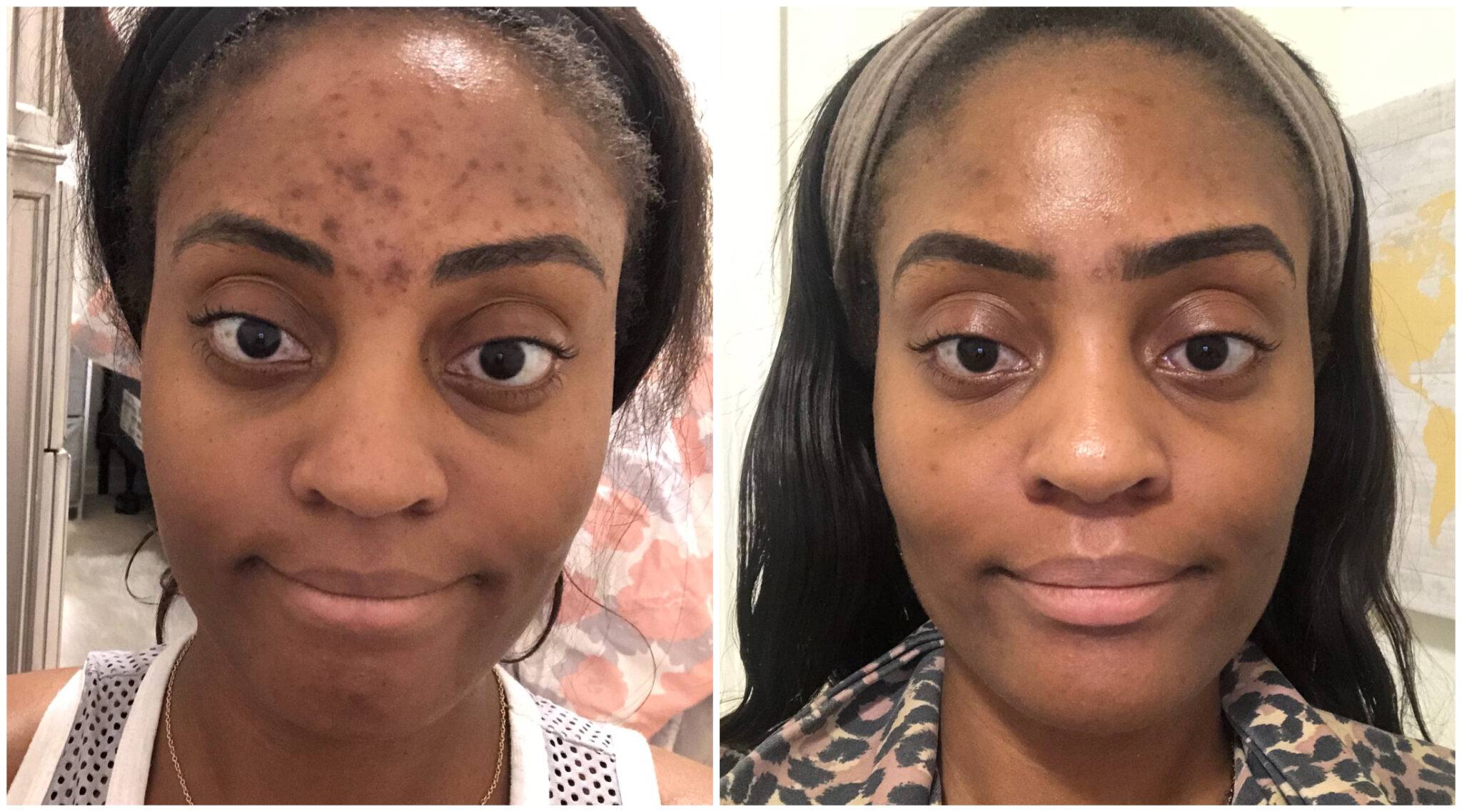 Tretinoin Before And After For 5 Skin Problems- Best For Acne? Find Out