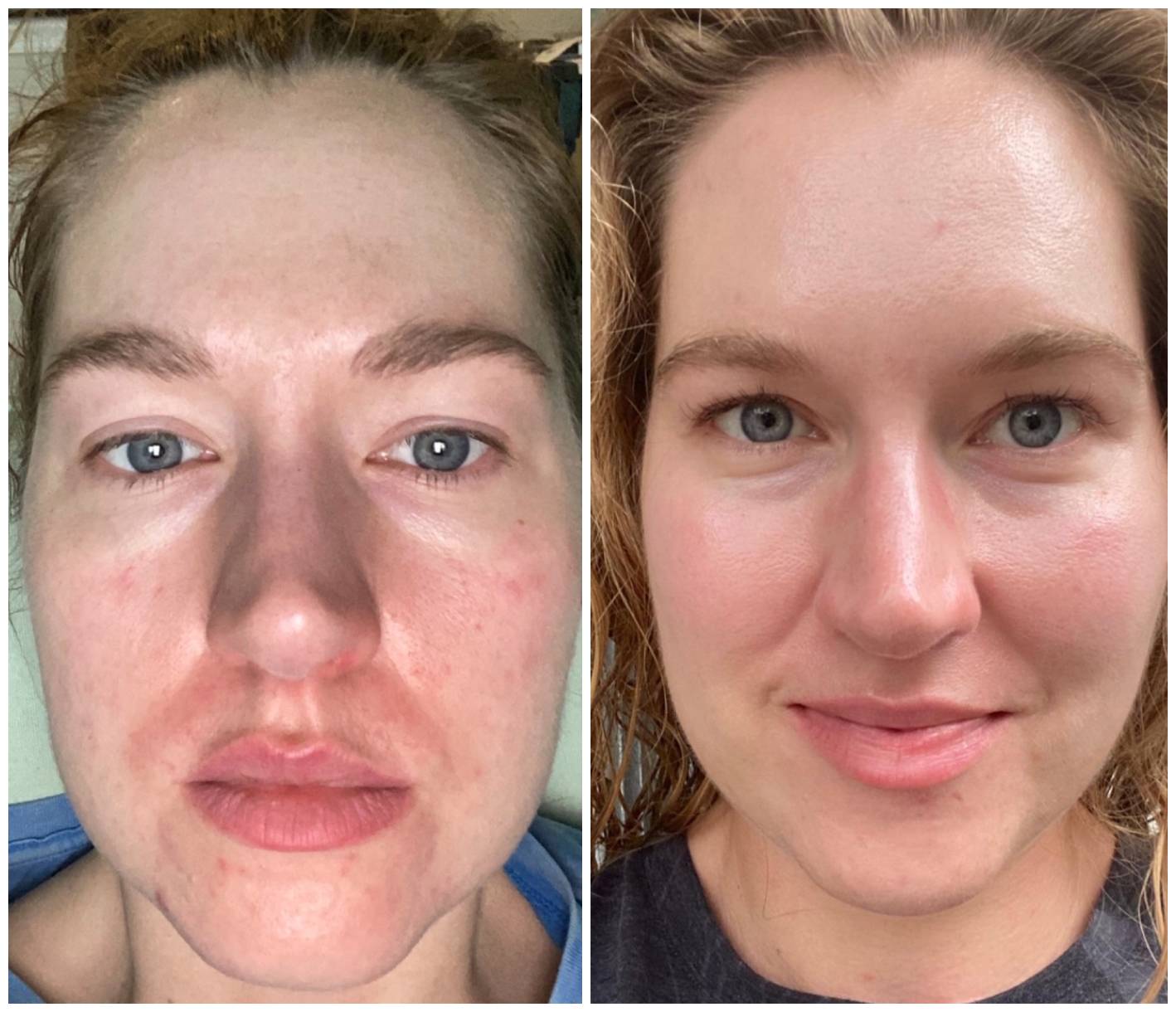 tretinoin before and after