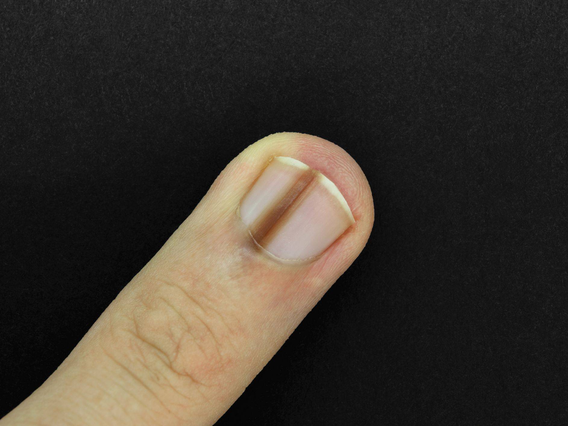 black line on nail