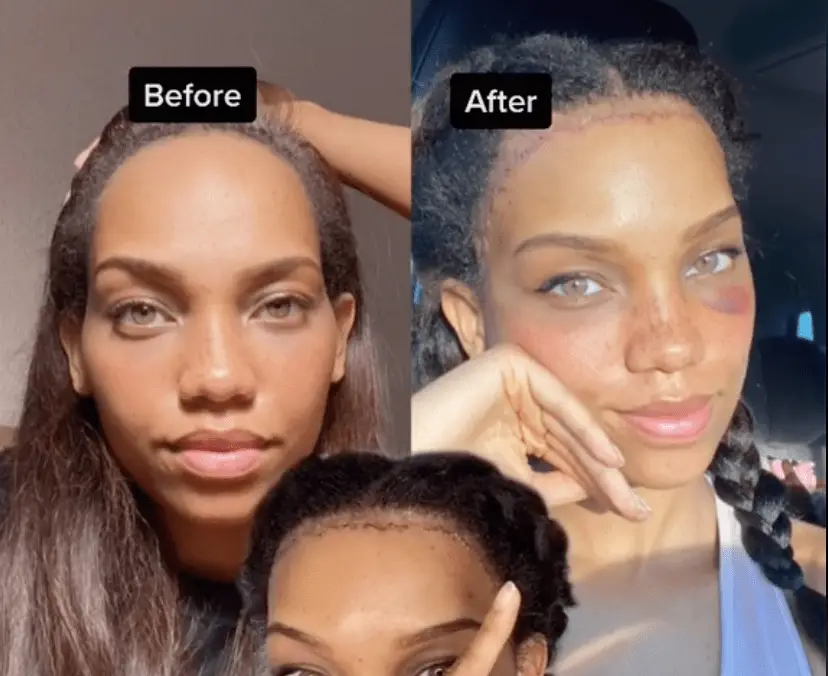 forehead reduction surgery