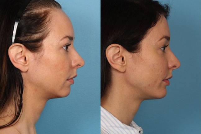 forehead reduction surgery