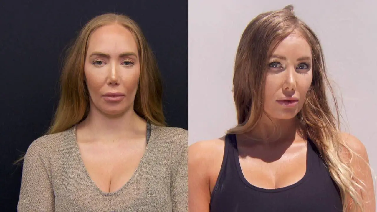 forehead reduction surgery