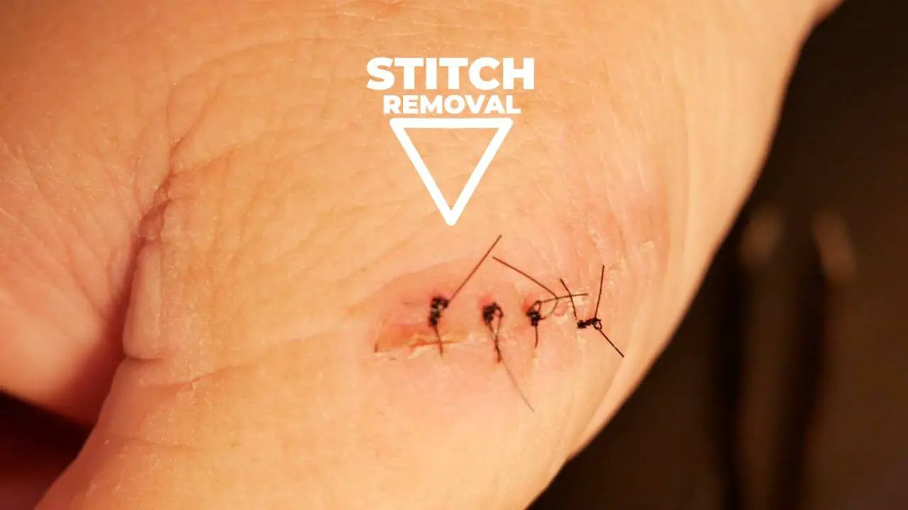 how to remove stitches