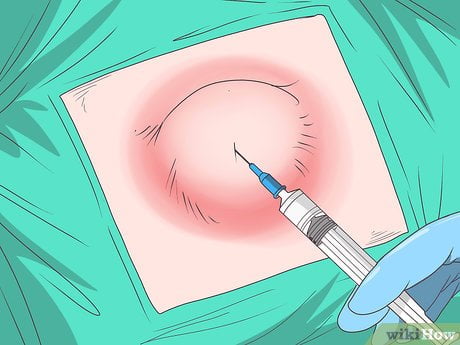 how to drain a cyst