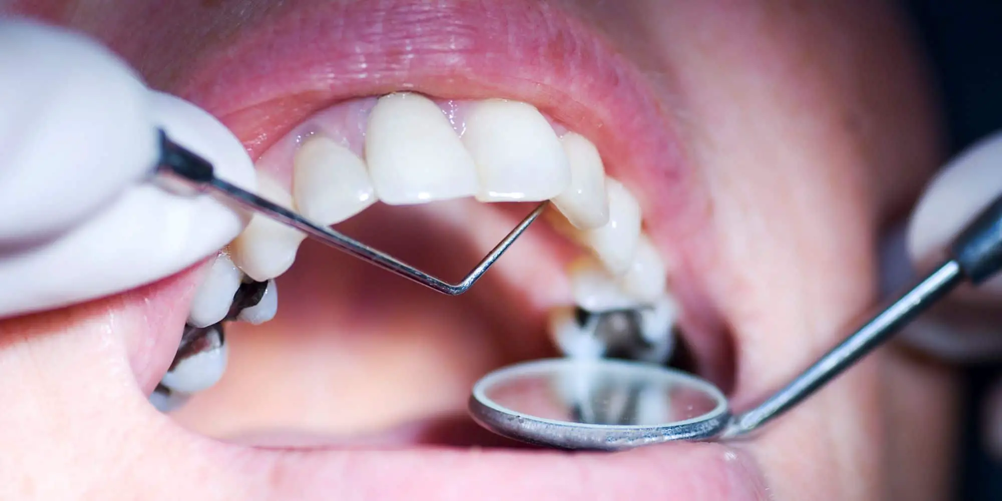 Can Cavities Heal: 7 Frequently Asked Questions Answered