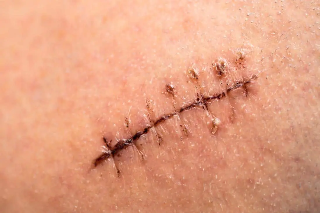 When To Get Stitches- 5 Important Factors To Determine!