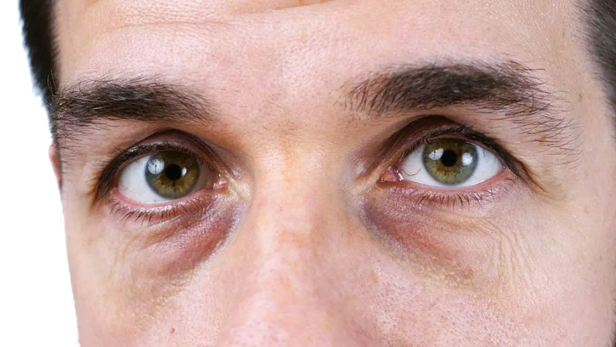how to remove dark circles under eyes for men