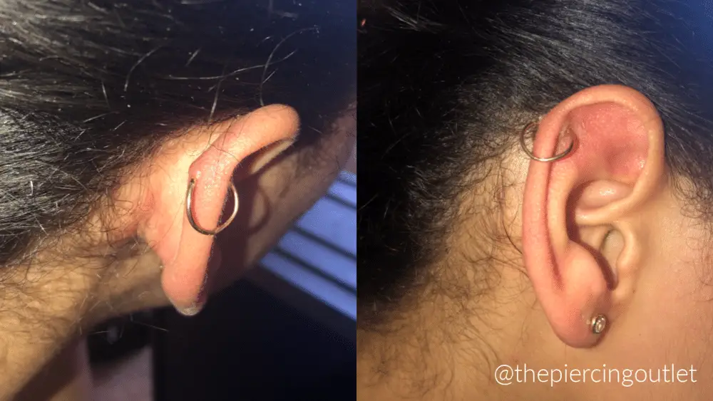 cartilage piercing bump