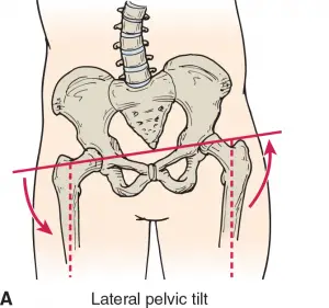 Lateral pelvic tilt 