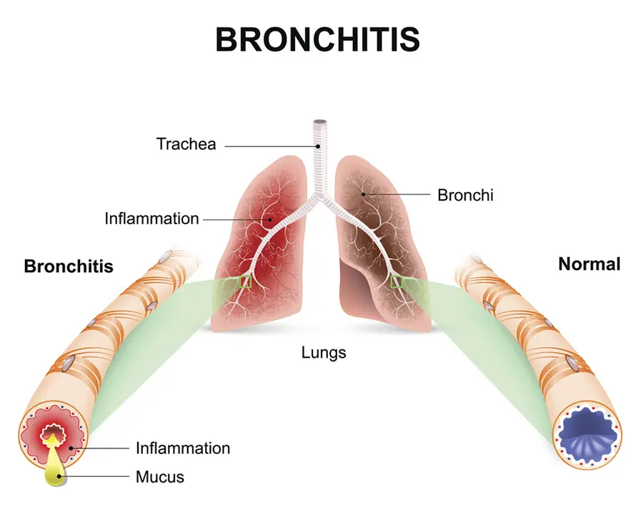 Chest Cold Symptoms 