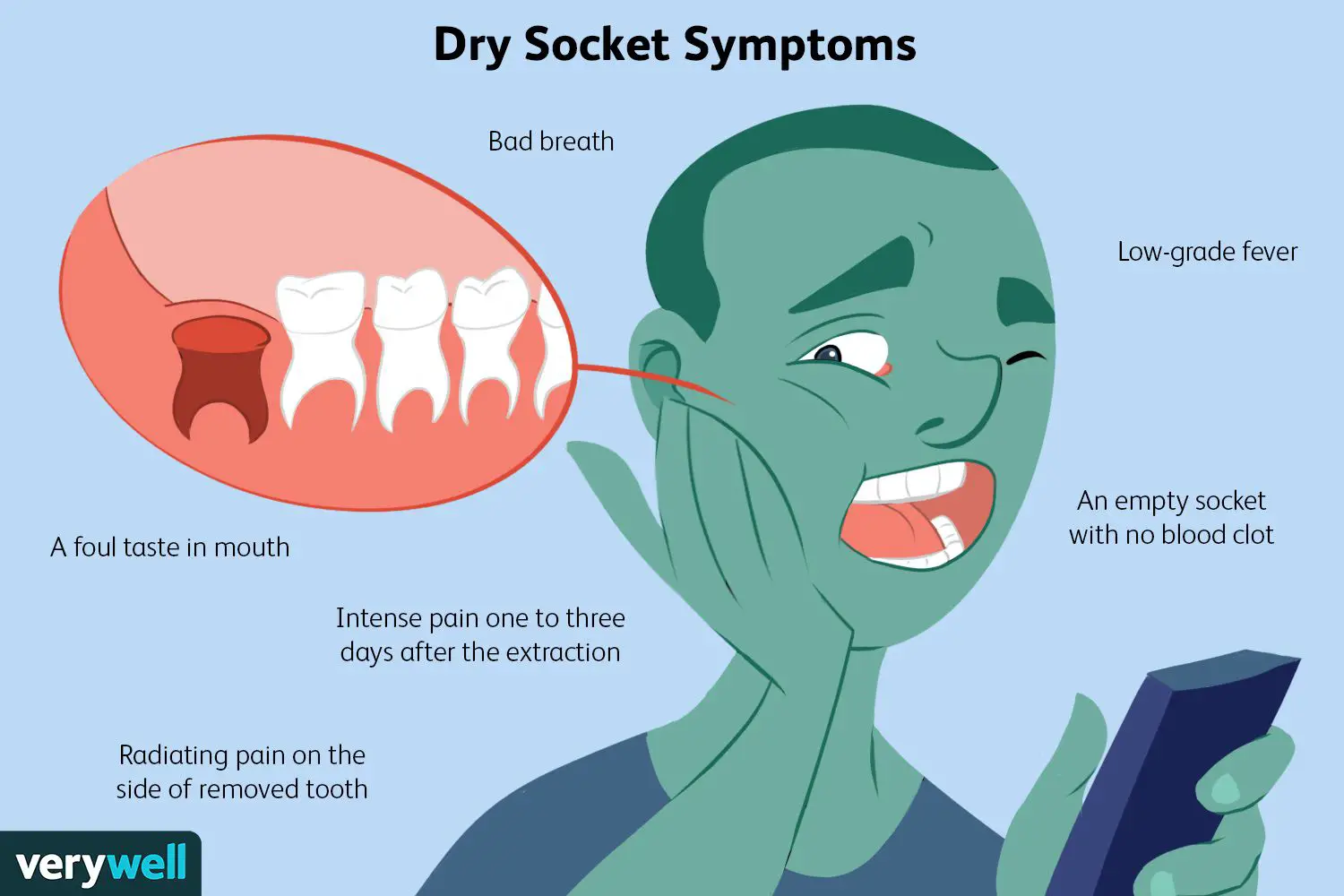 how to prevent dry socket after tooth extraction