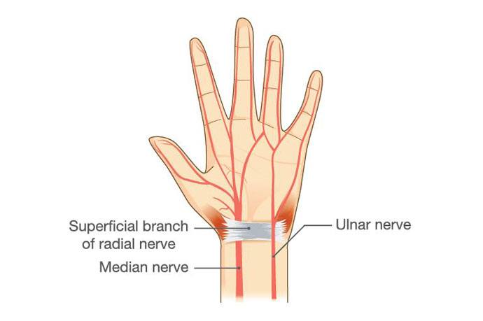 numbness in hands while sleeping