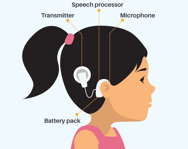 cochlear implant cost