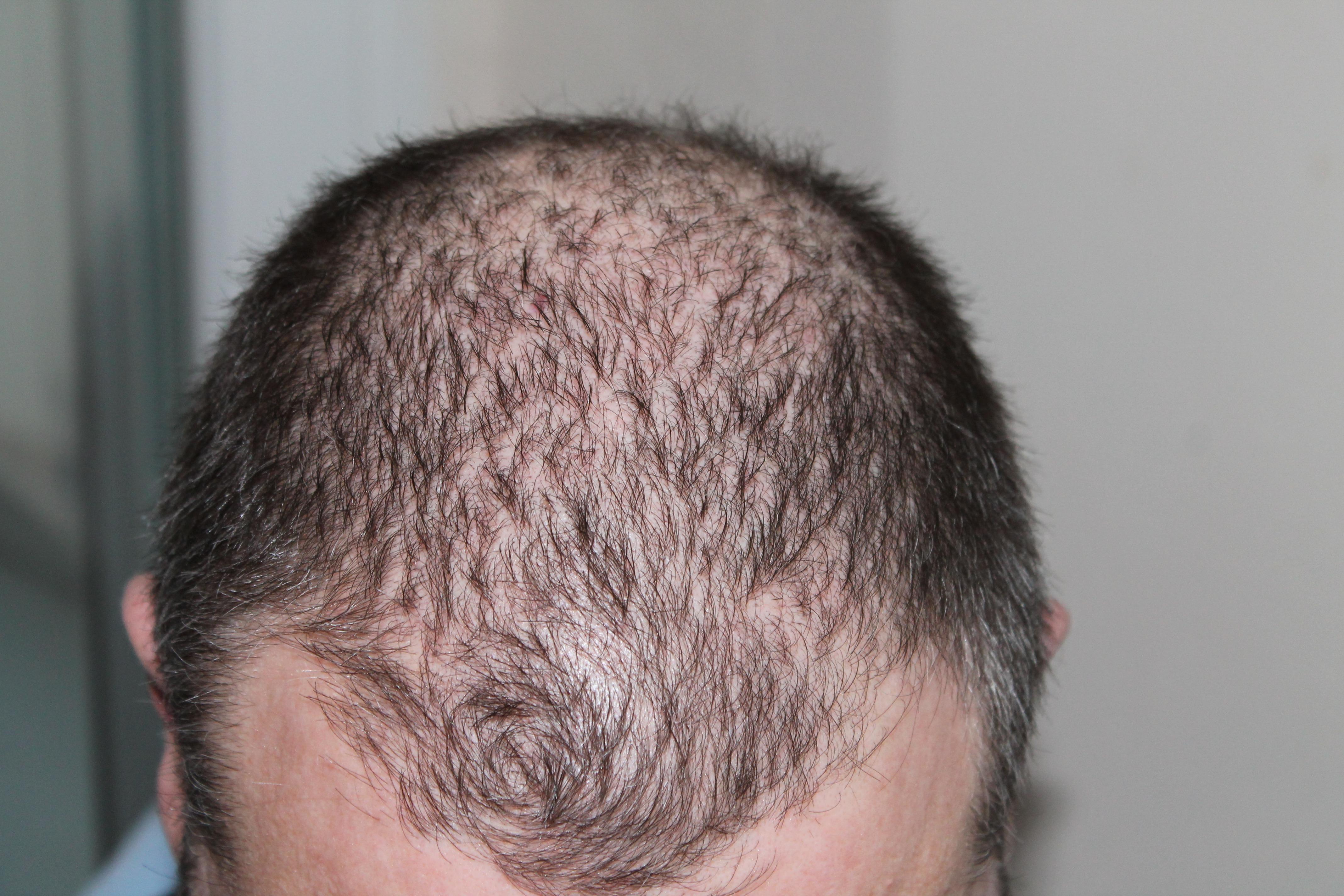 hair, man, hair loss