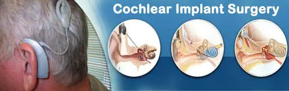 cochlear implant cost