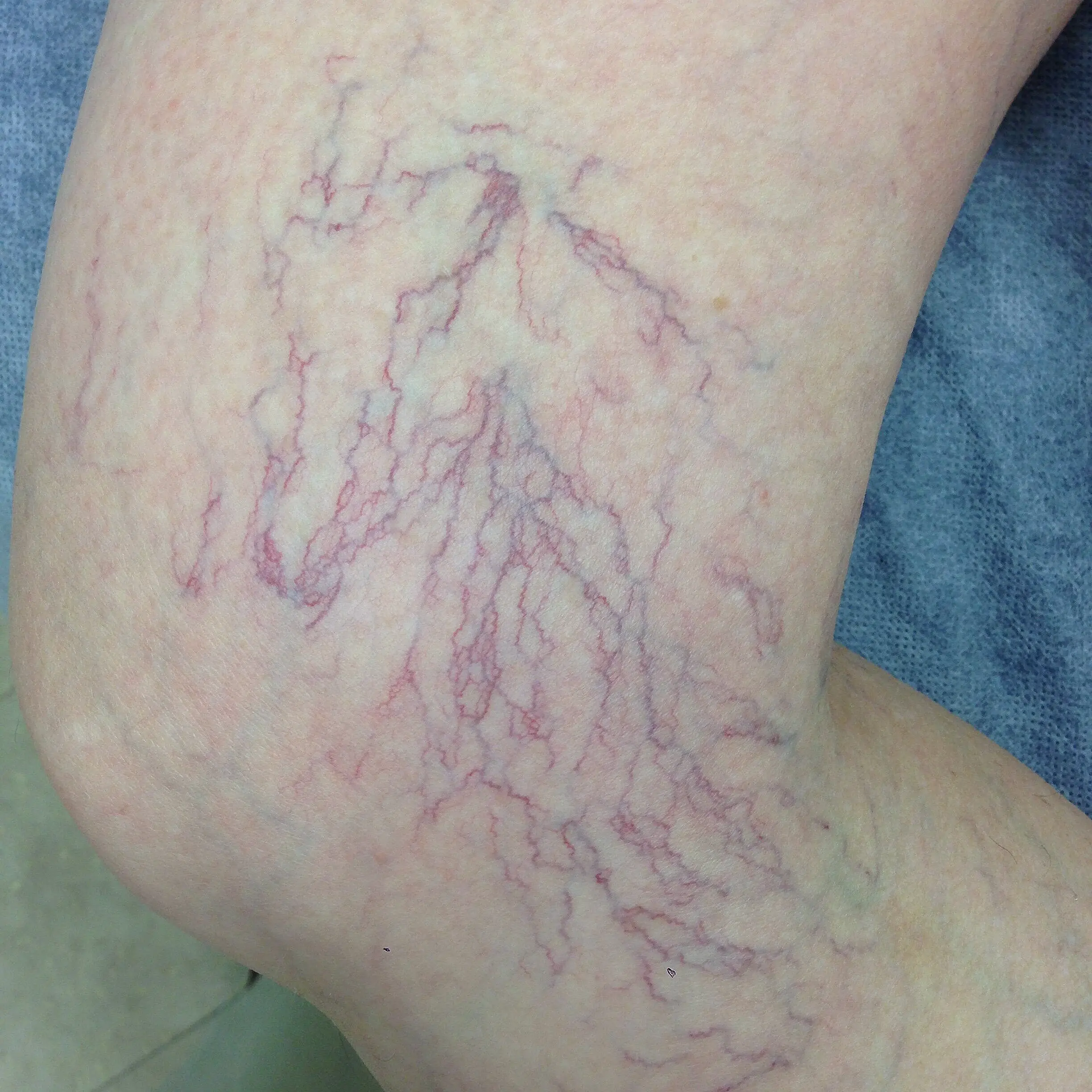 Why Do Spider Veins Occur? 7 Causes And Treatment